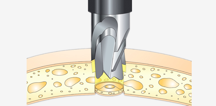 Meridian alpha™ Single-Use Perforators from Rycol Medical in Ireland