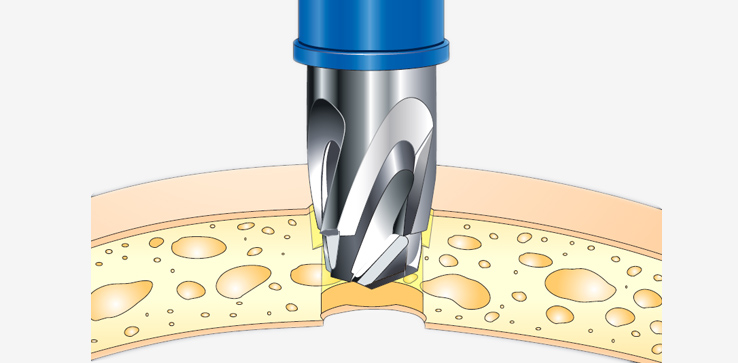 Meridian Classic™ Single-Use Perforators from Rycol Medical in Ireland