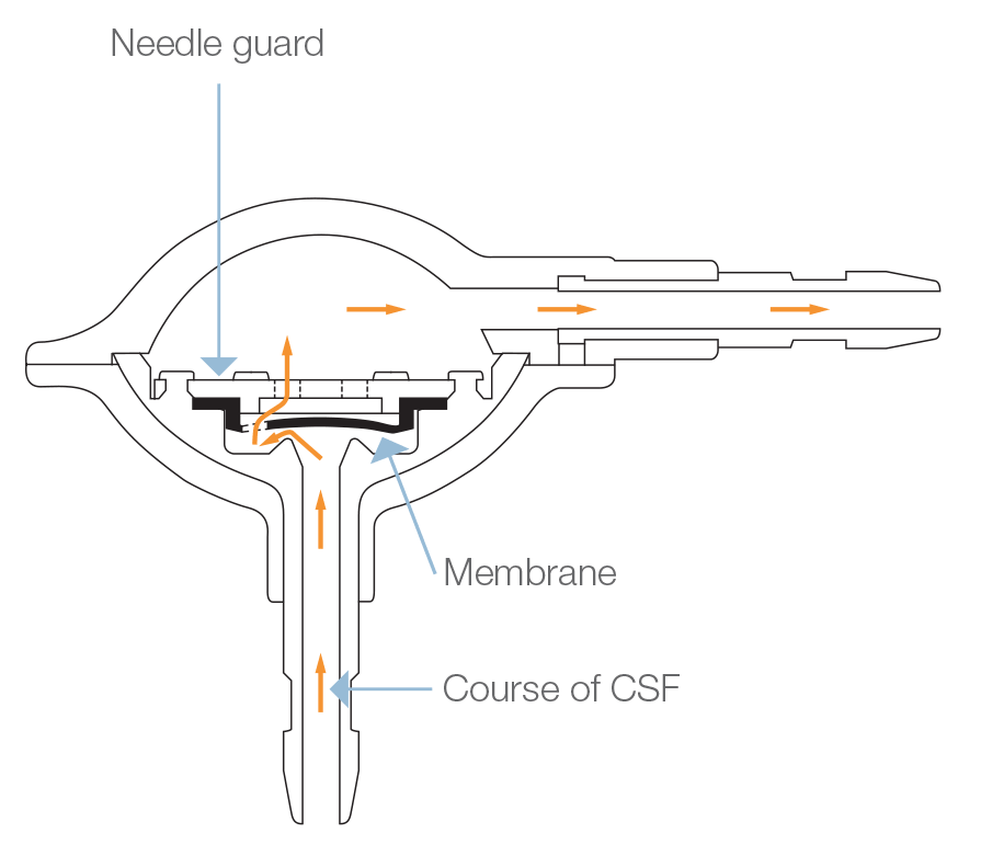 The Pulsar® Monopressure Valve cross section  flow from Rycol Medical in Ireland